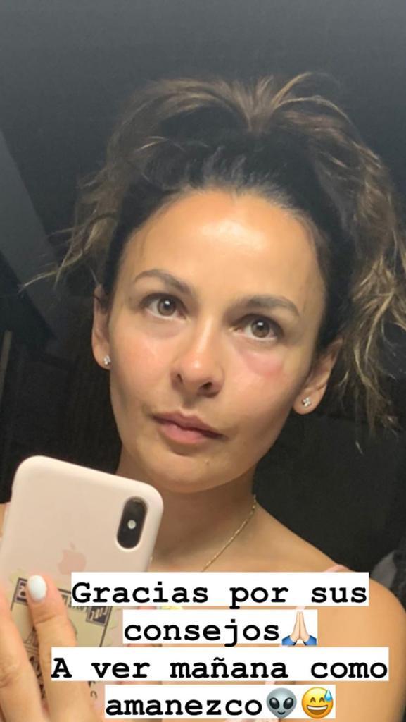 carla pardo fue picada por un zancudo