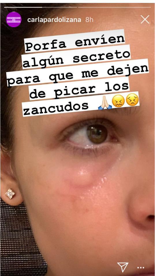 Carla Pardo picada de zancudo