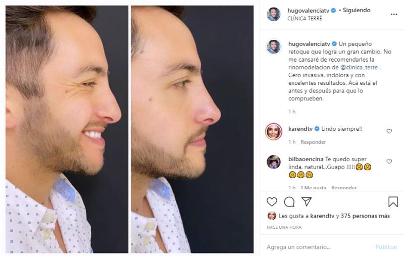 Hugo Valencia enseña cómo quedó tras retocarse la nariz