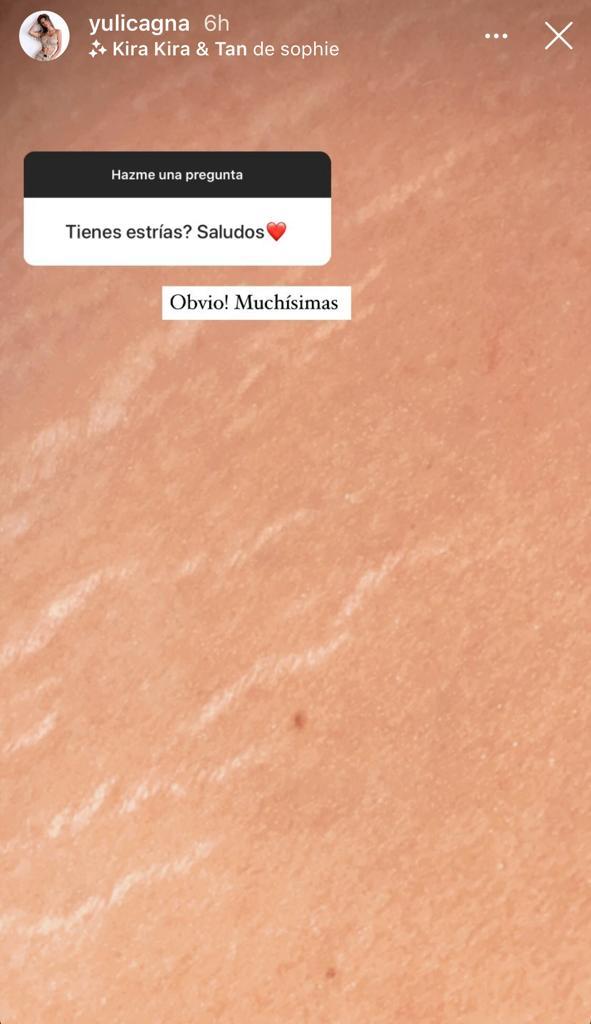 Yuli Cagna enseña sus estrías y cuenta lo que se hizo en el rostro