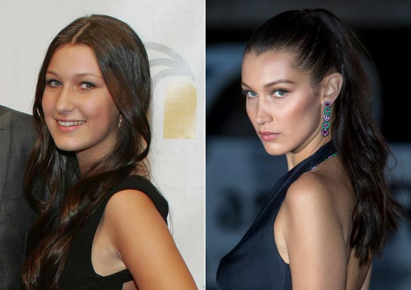 Bichectomía Bella Hadid