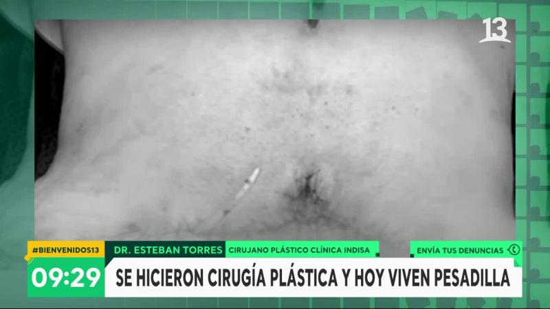 fallida cirugía estética