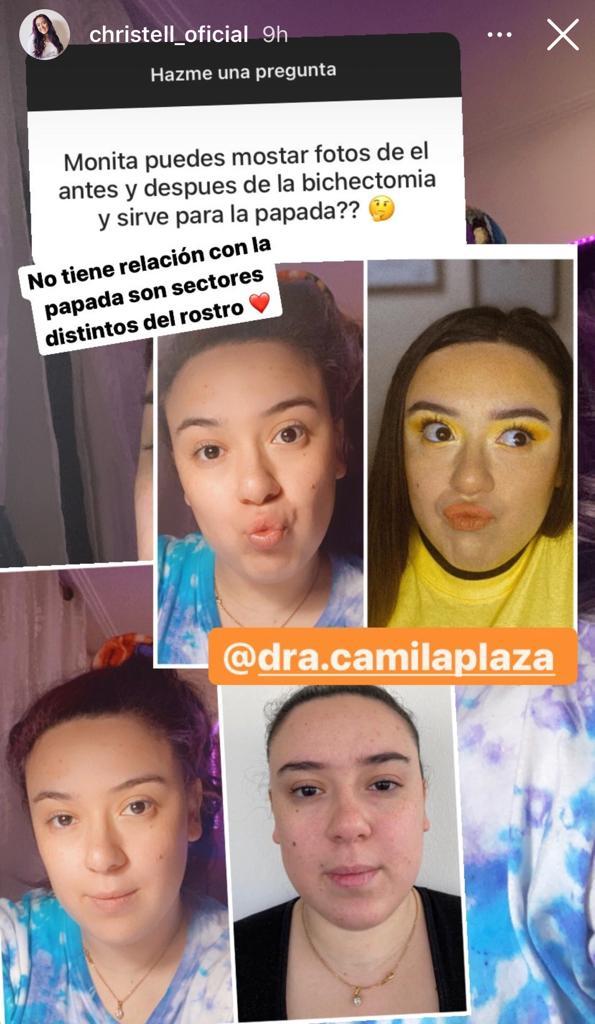 Christell muestra su radical cambio tras someterse a bichectomía