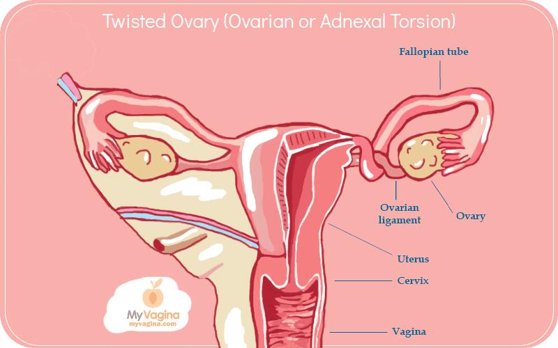 Torsión ovárica