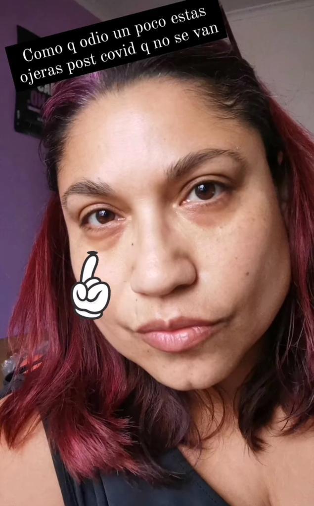 Ale Valle muestra consecuencias faciales que le dejó el coronavirus