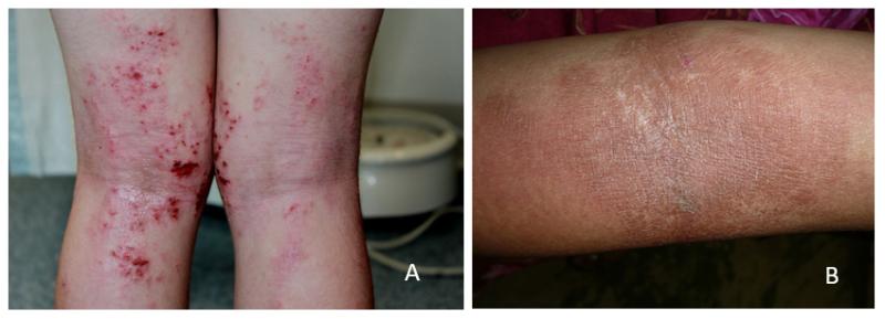 Dermatitis atópica