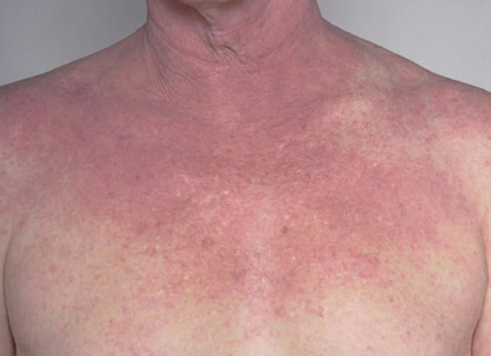 Dermatitis atópica