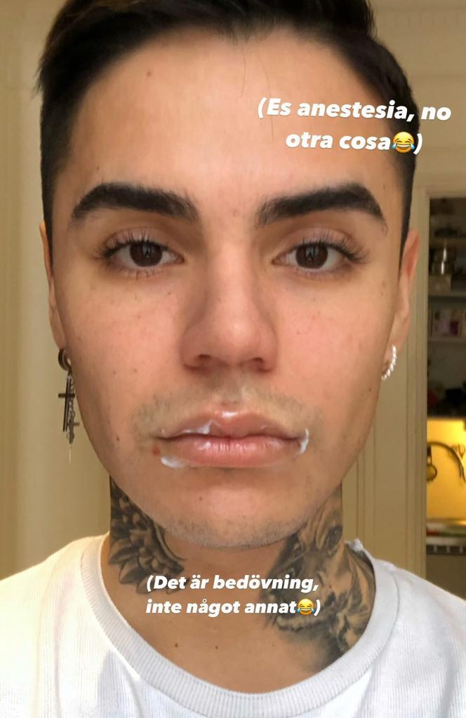 Así quedó Leo Méndez Jr. tras aumentar el tamaño de sus labios