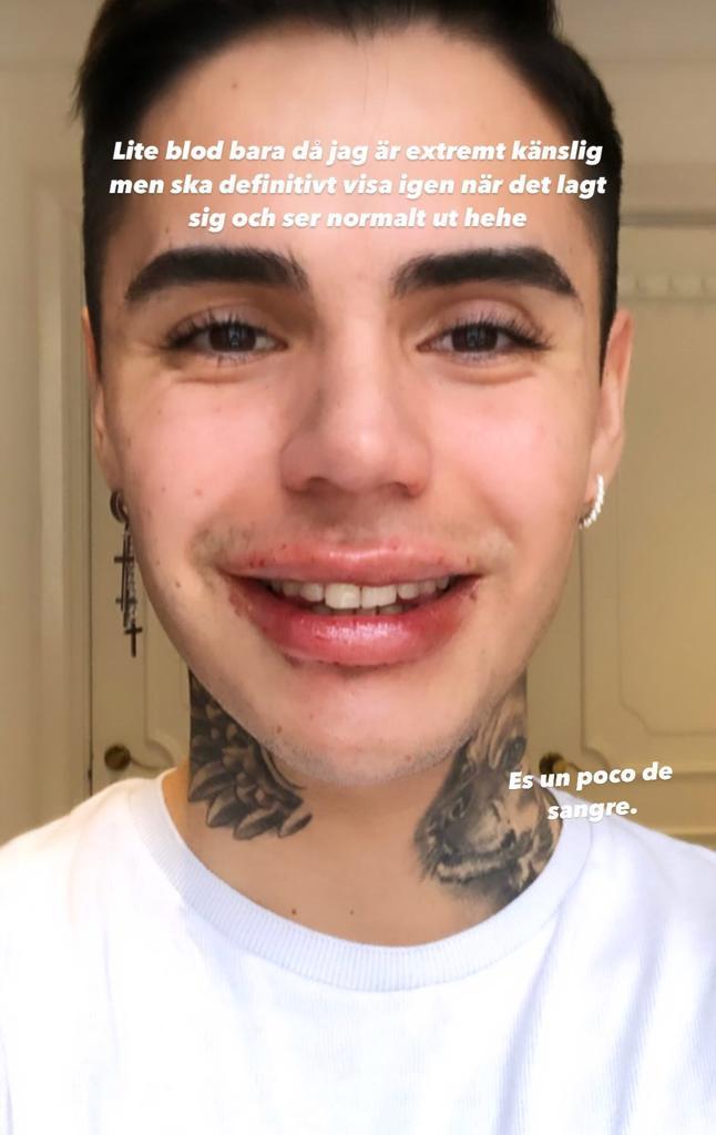 Así quedó Leo Méndez Jr. tras aumentar el tamaño de sus labios