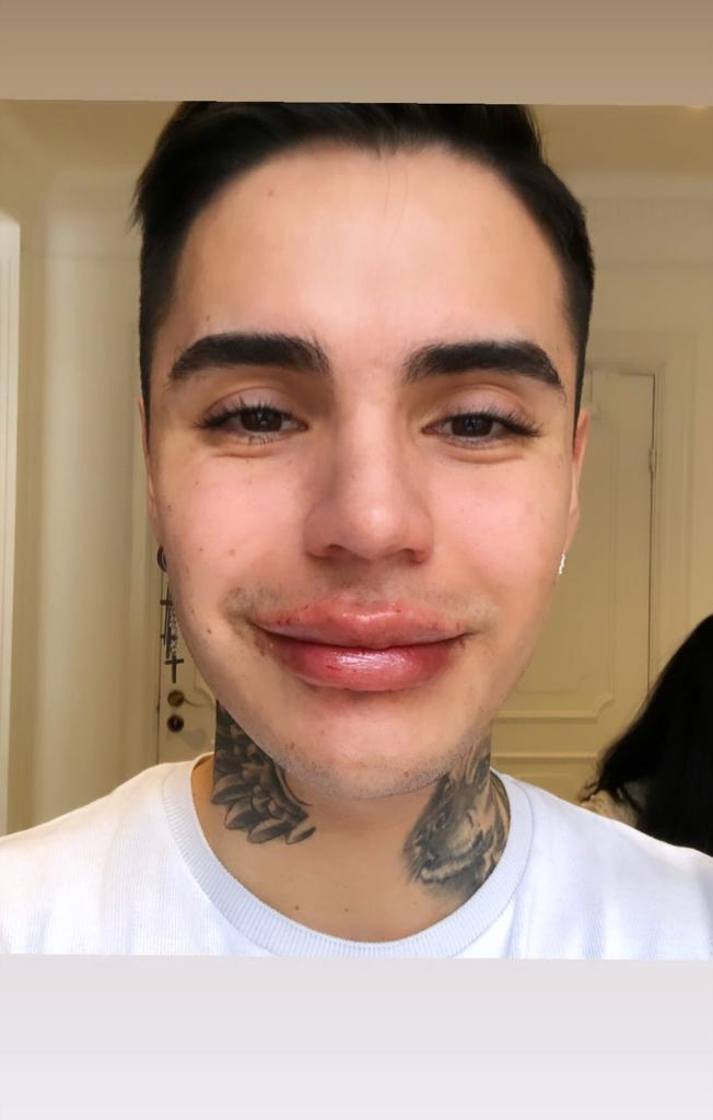 Así quedó Leo Méndez Jr. tras aumentar el tamaño de sus labios