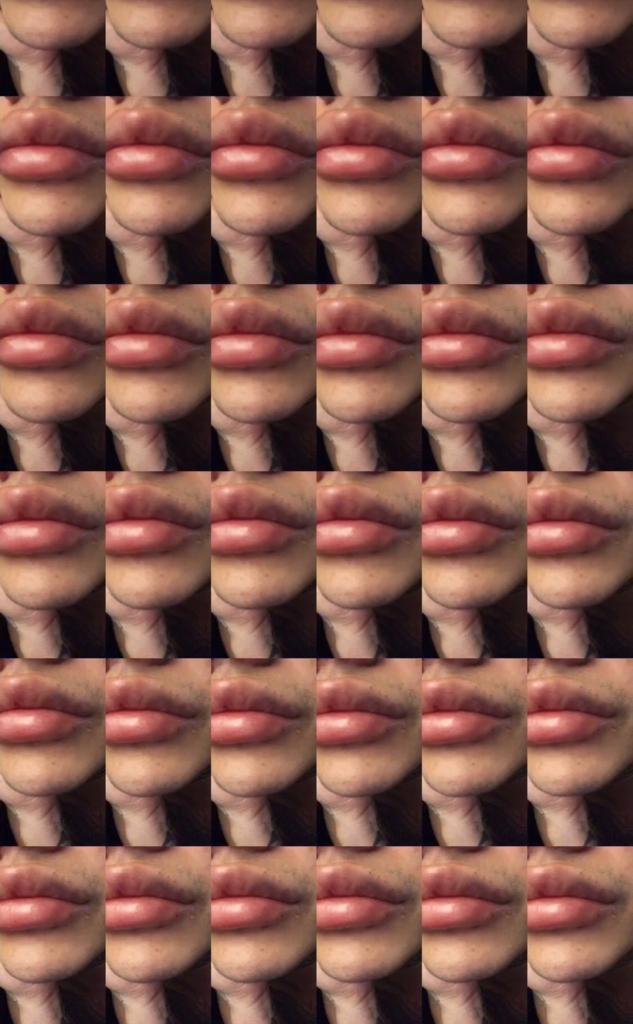 Así quedó Leo Méndez Jr. tras aumentar el tamaño de sus labios