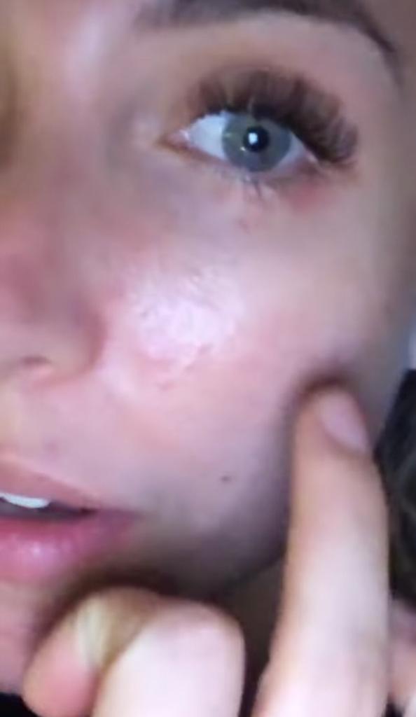 “No sé qué hacer”: Ángela Duarte sufre por los granos en su cara