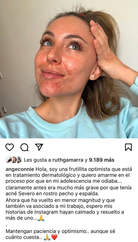 “Soy una frutillita”: Ángela Duarte destapa su lucha contra el acné