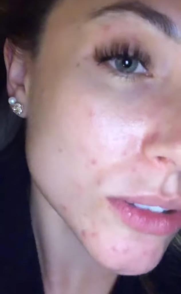 “No sé qué hacer”: Ángela Duarte sufre por los granos en su cara