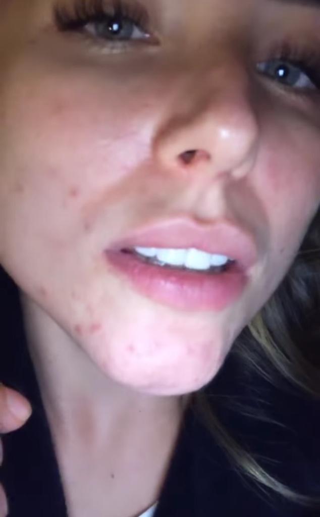 “No sé qué hacer”: Ángela Duarte sufre por los granos en su cara