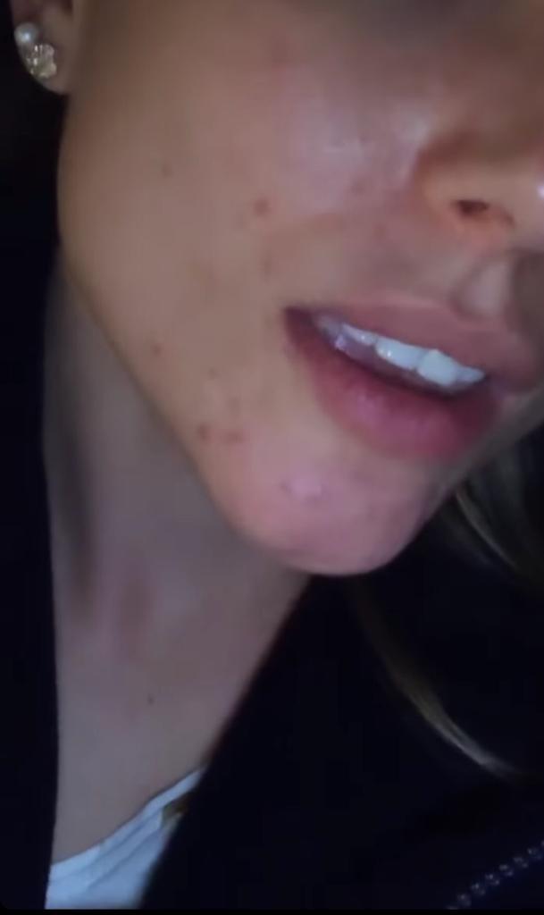 “No sé qué hacer”: Ángela Duarte sufre por los granos en su cara