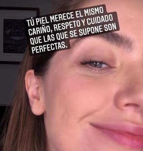 Millaray Viera pide respeto por las pieles imperfectas