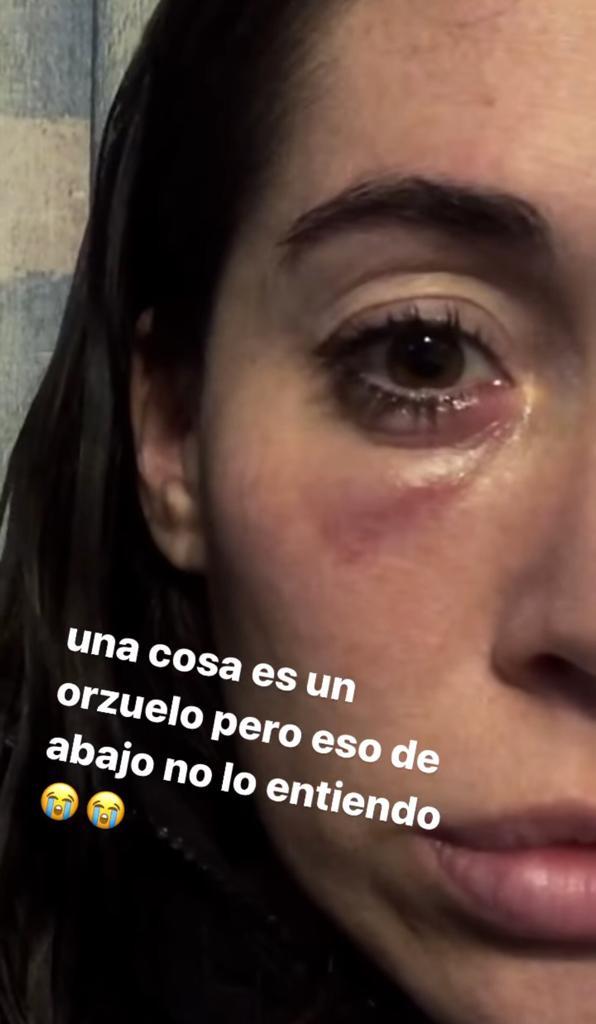 Vale Roth preocupa por rara erupción en su rostro