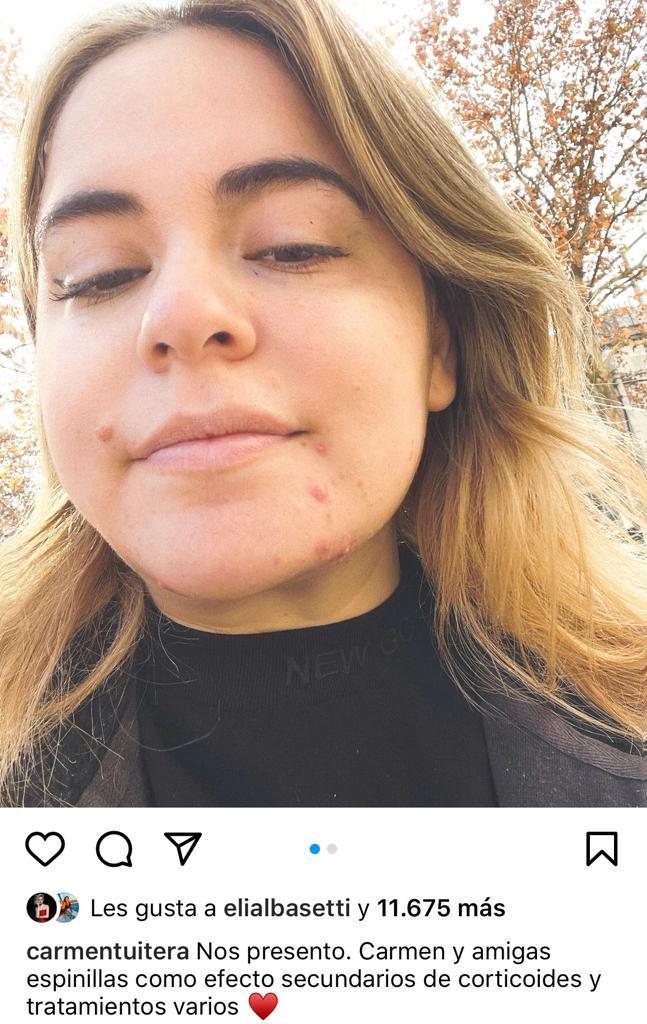 Carmen Tuitera exhibe las consecuencias faciales de tratamiento