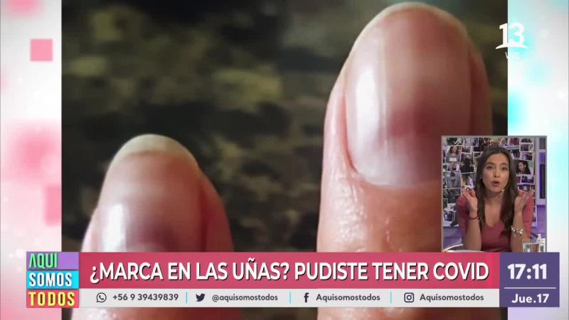 ¡Atención! Estas marcas podrían indicar que tuviste Covid