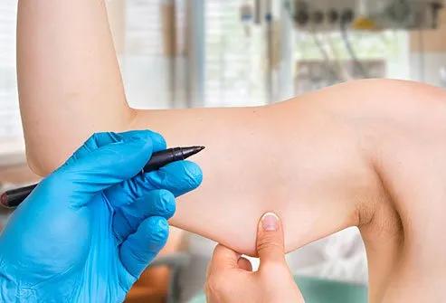 Does It Matter Where Nexplanon Is Inserted?