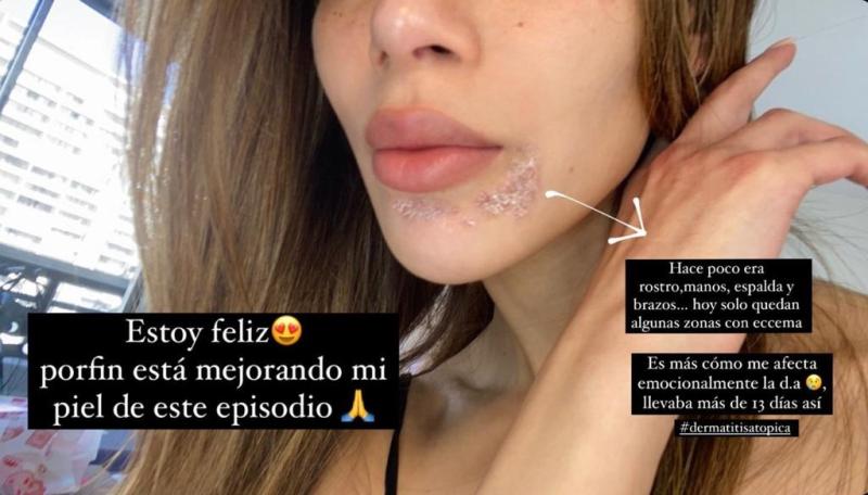 Silvina Varas muestra efectos de enfermedad que afecta su piel