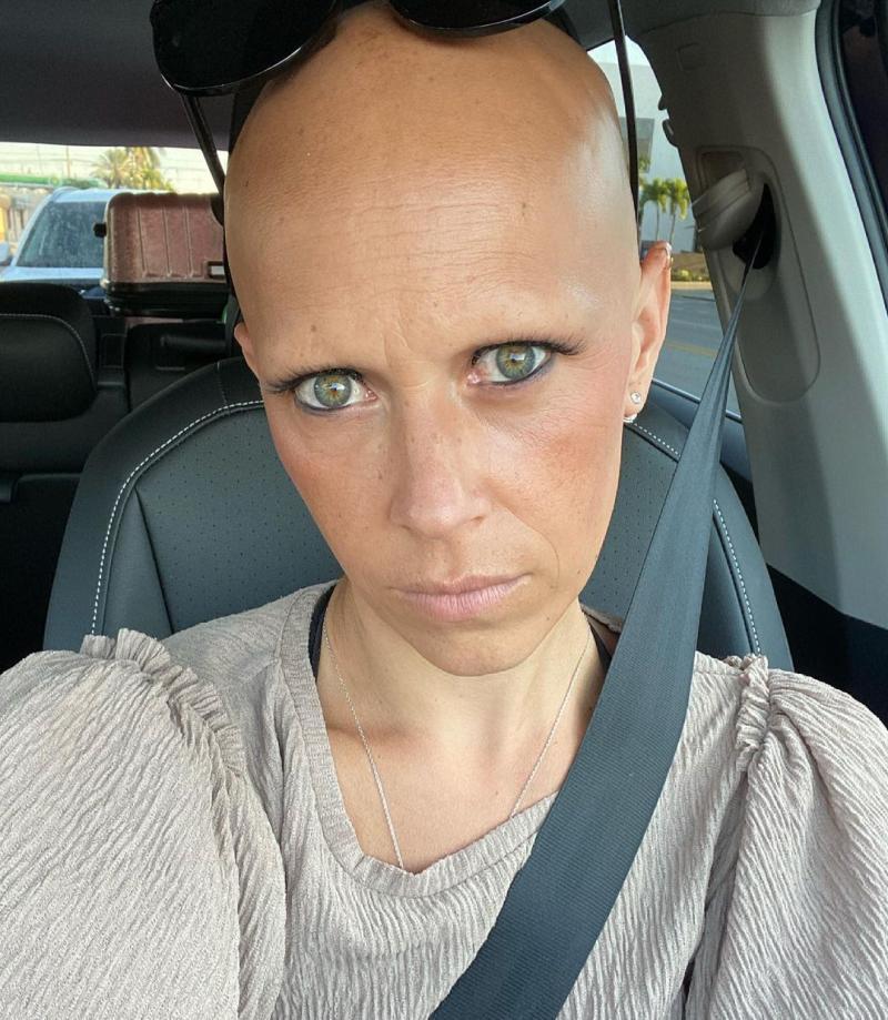 Monik perdió todo su pelo por enfermedad autoinmune