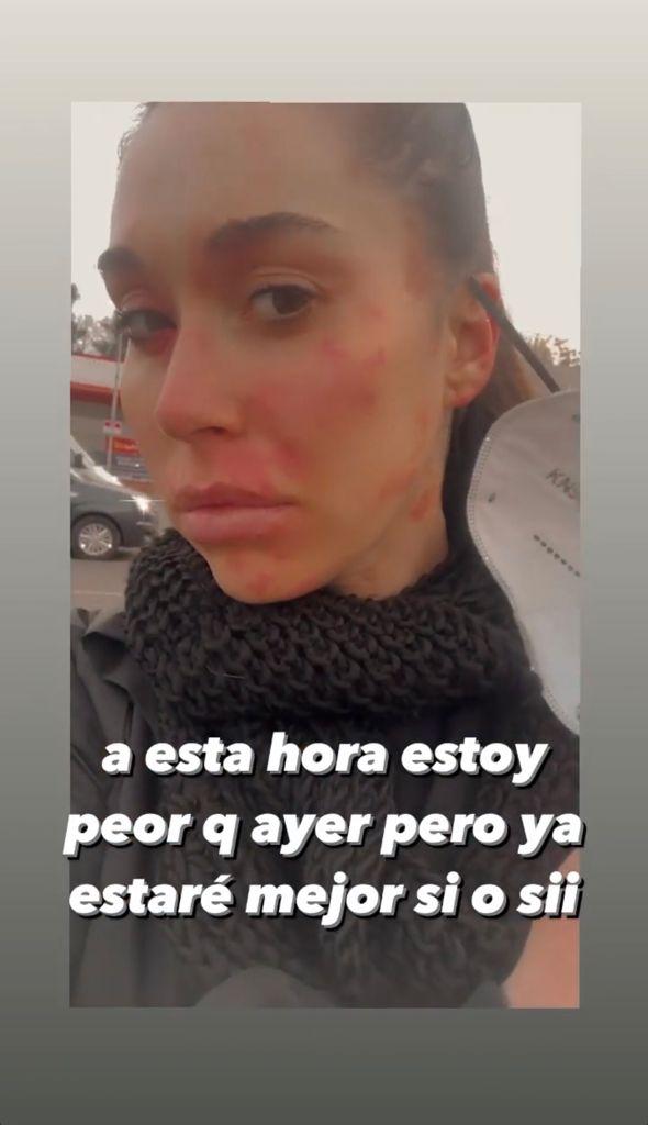 Vale Roth impacta al mostrar feroz reacción alérgica