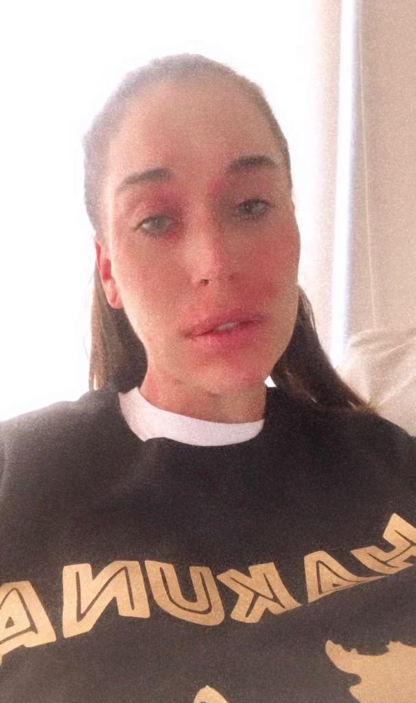 Vale Roth impacta al mostrar feroz reacción alérgica