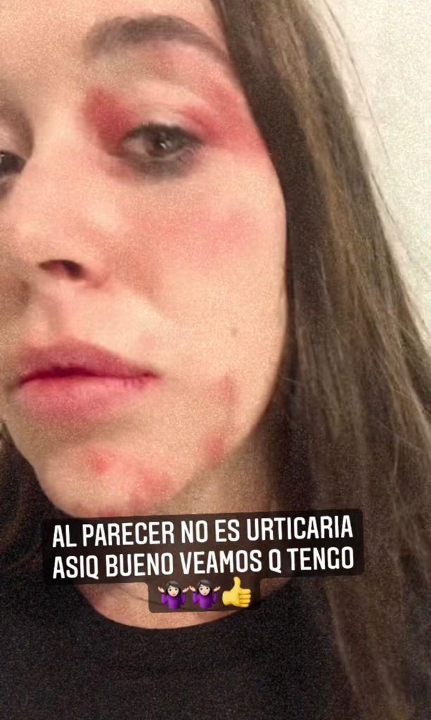 Vale Roth impacta al mostrar feroz reacción alérgica