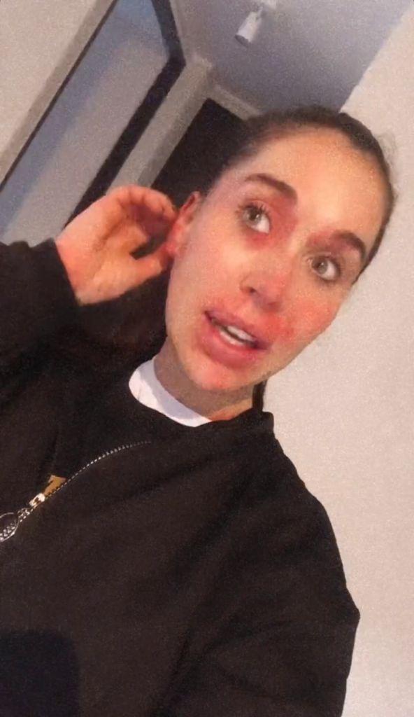 Vale Roth impacta al mostrar feroz reacción alérgica