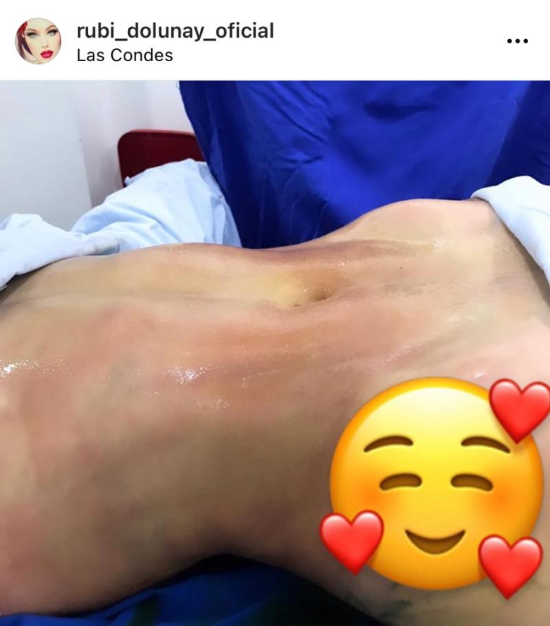 Rubí Galusky muestra los resultados de su última cirugía estética