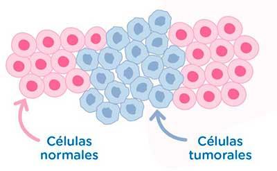 Producción de cáncer de pulmón
