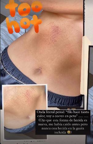 Kel Calderón muestra sus heridas tras fuerte caída