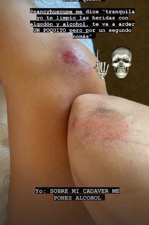 Kel Calderón muestra sus heridas tras fuerte caída