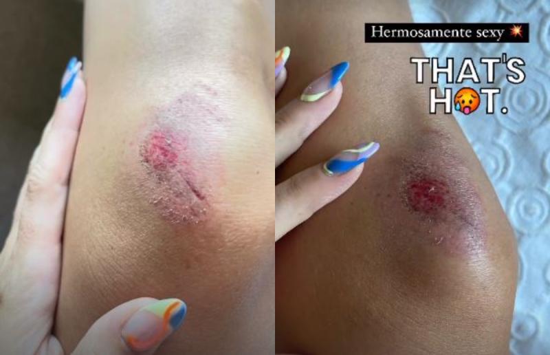 Kel Calderón muestra sus heridas tras fuerte caída