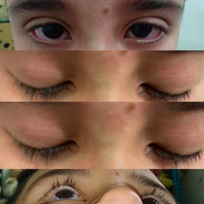 niño al que le arrancaron las pestañas