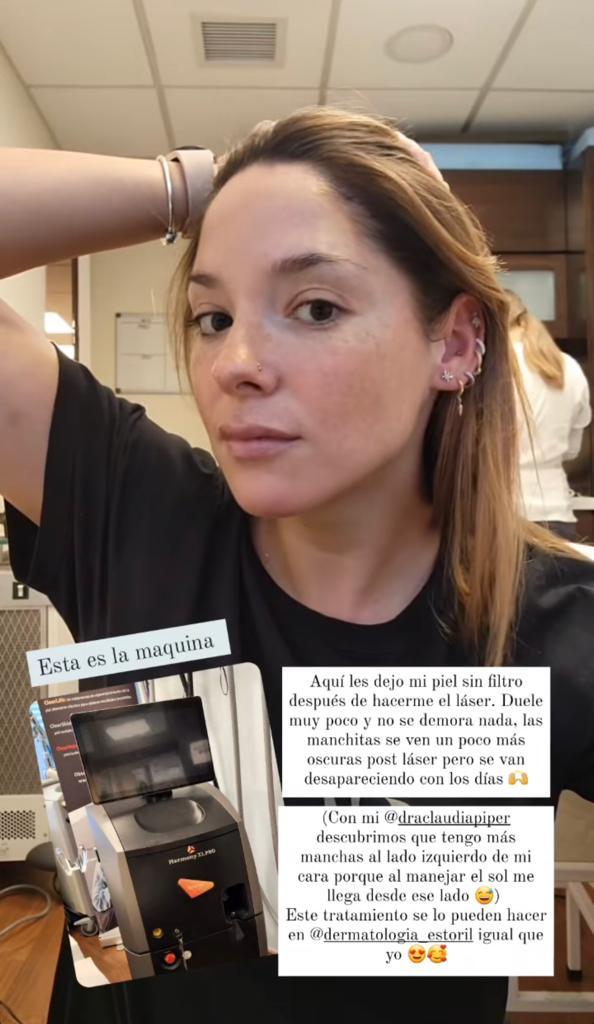 Kel Calderón se muestra sin filtro por procedimiento estético