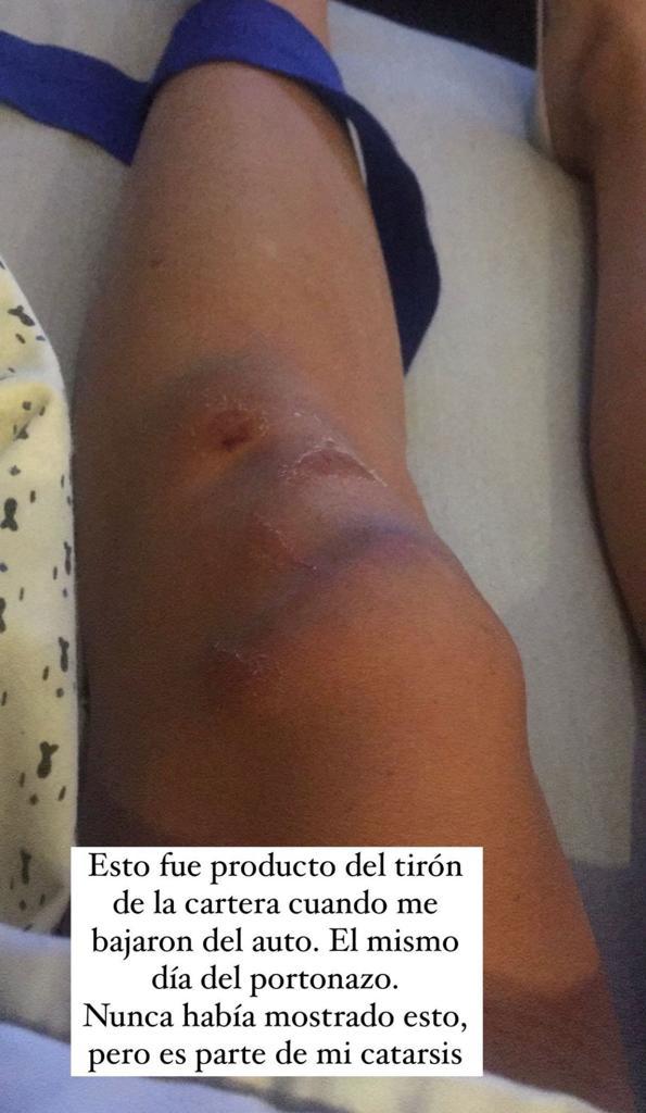 Gianella Marengo mostró cómo quedaron sus piernas tras portonazo