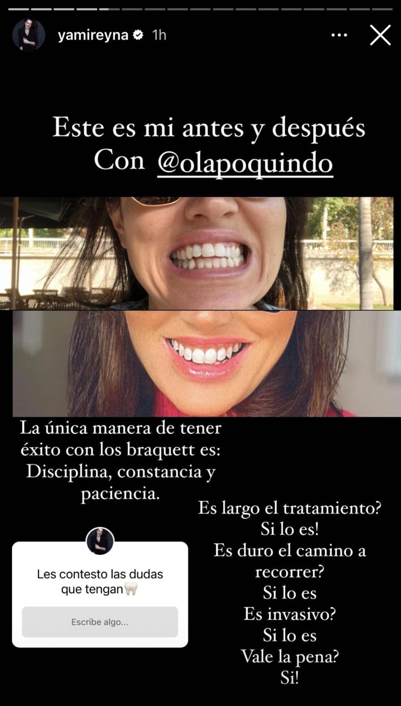 Yamila Reyna muestra el antes y después de su proceso dental