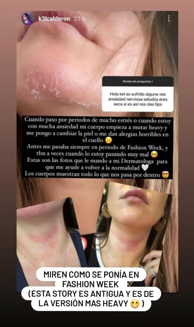 Kel Calderón ya ha sufrido de esta alergia anteriormente