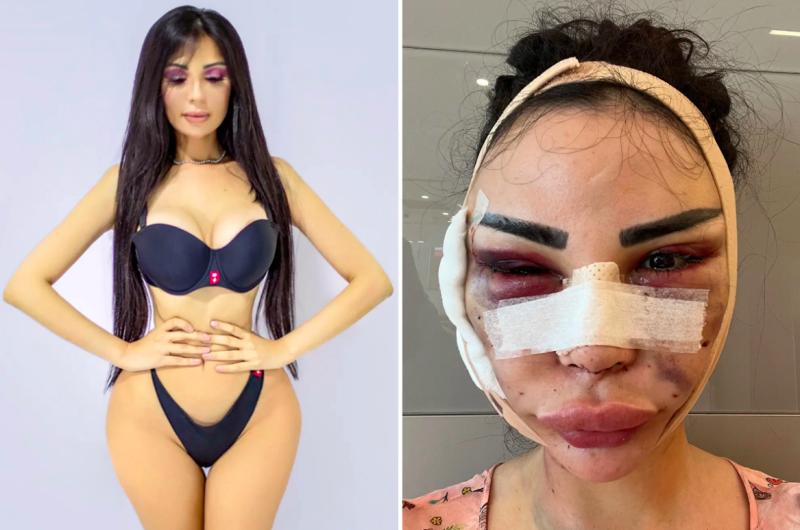 Mujer que gastó $600 millones para ser como Kim Kardashian revierte cirugías