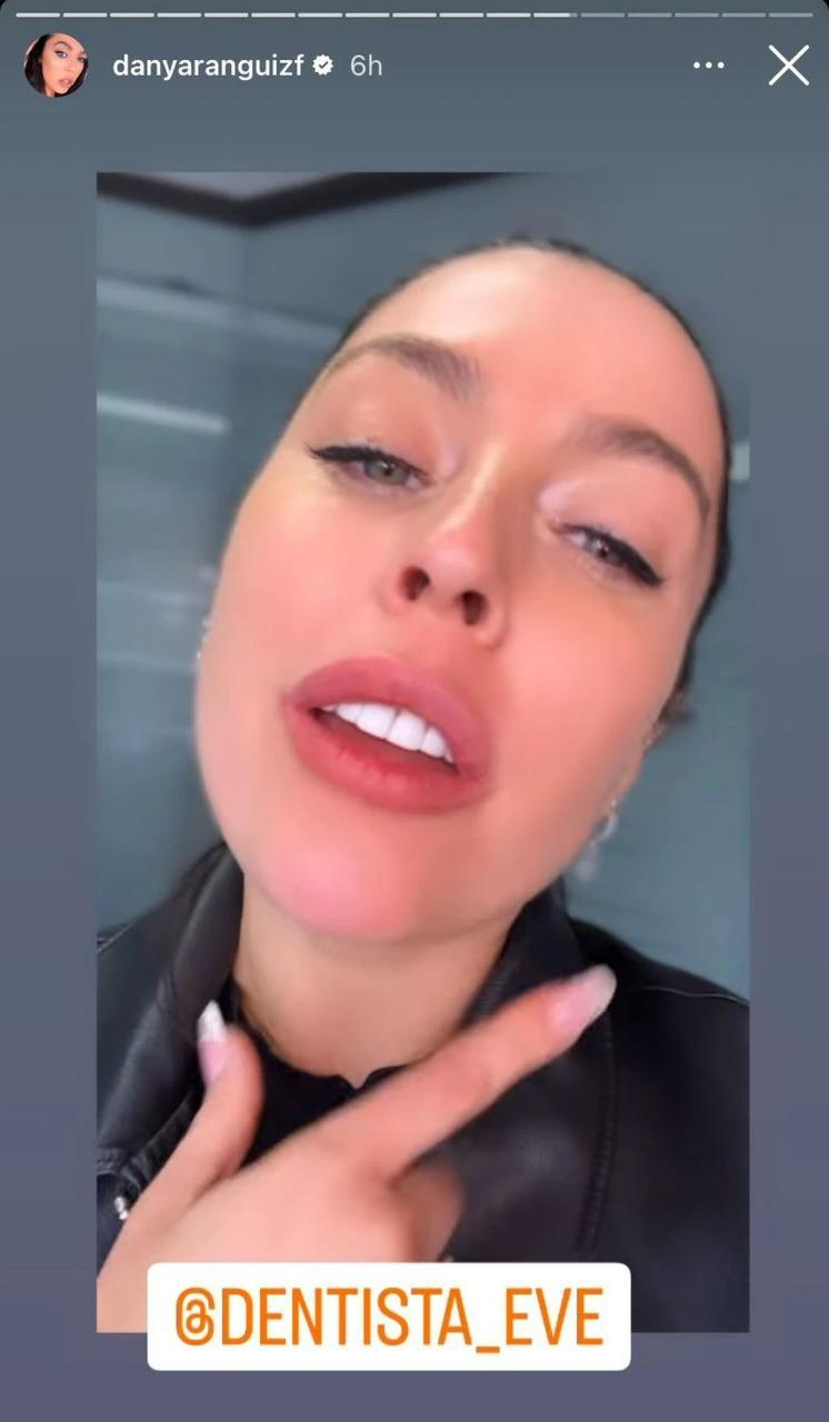 Daniela Aránguiz contó en junio que se rellenó sus labios