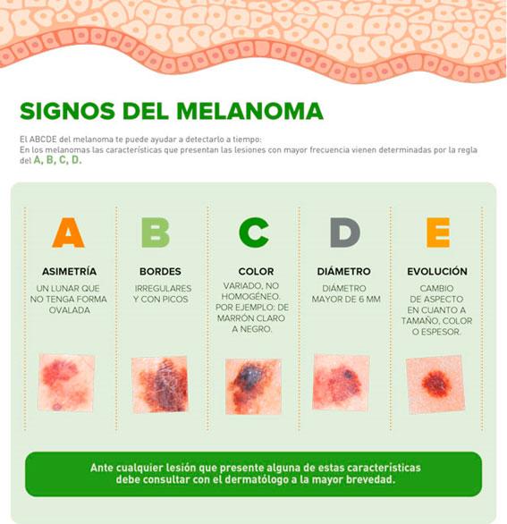 melanoma