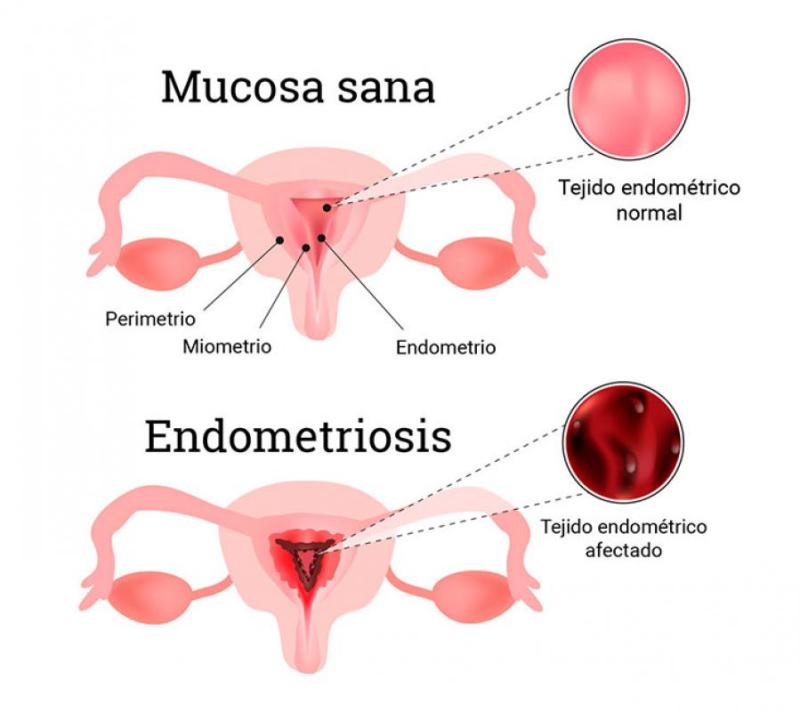 Endometriosis