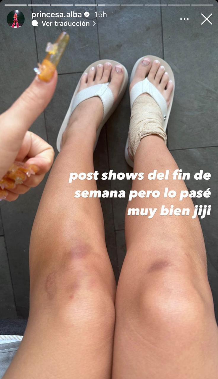 Princesa Alba sufrió doloroso accidente sobre el escenario: mostró cómo quedó su tobillo