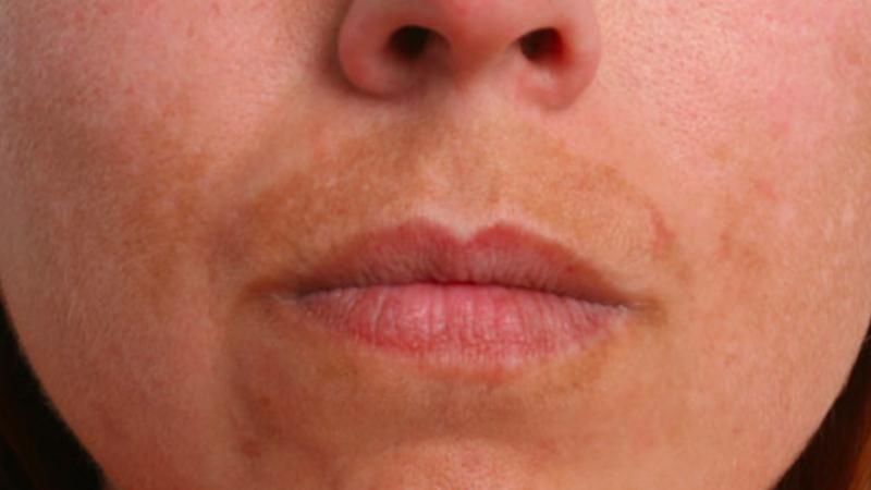 Manchas en el bigote: ¿por qué salen y cómo deshacernos de ellas?