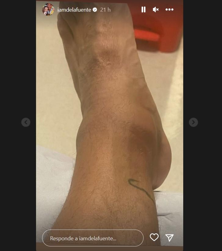 Tobillo lesionado de Cristián de la Fuente
