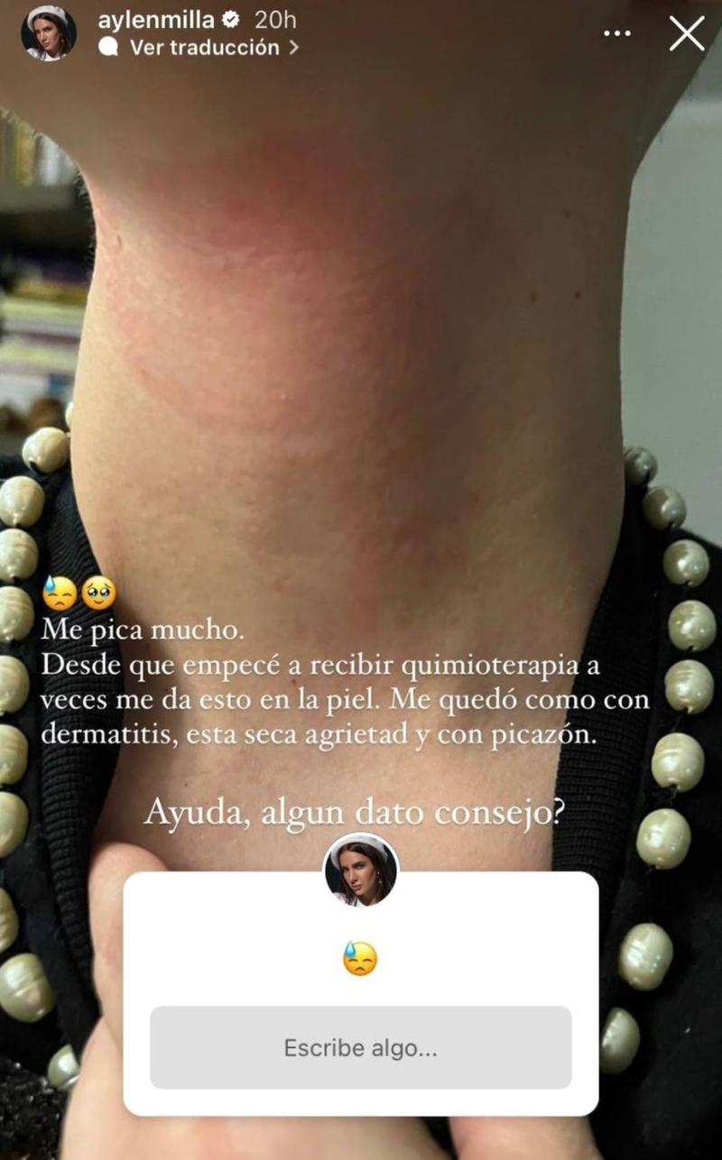 Aylén Milla mostró efectos de la quimioterapia en su piel.