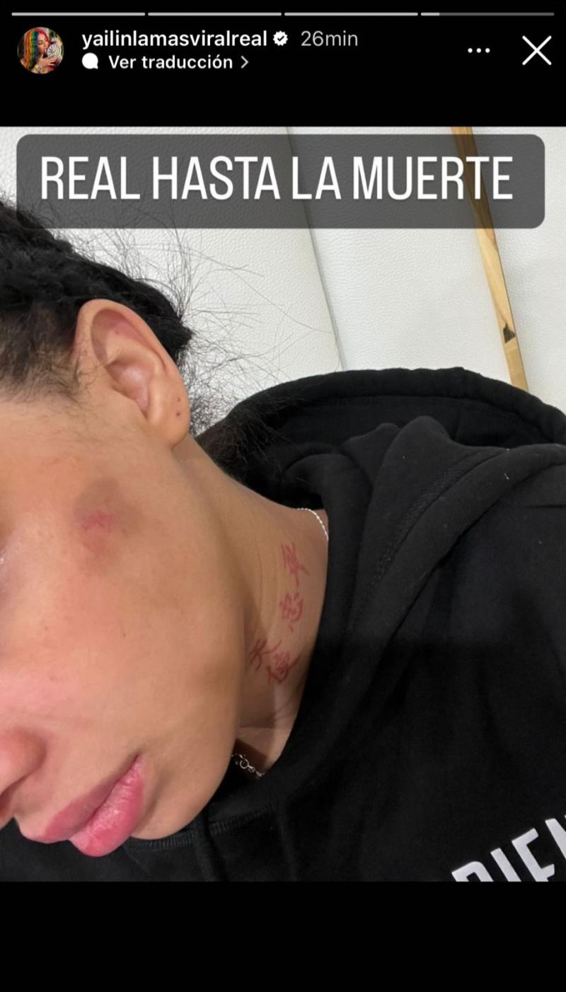 Yailin muestra imágenes golpeada